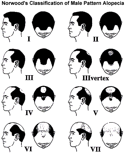 hair transplant infographic