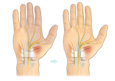 Treatment Options for Carpal Tunnel Syndrome