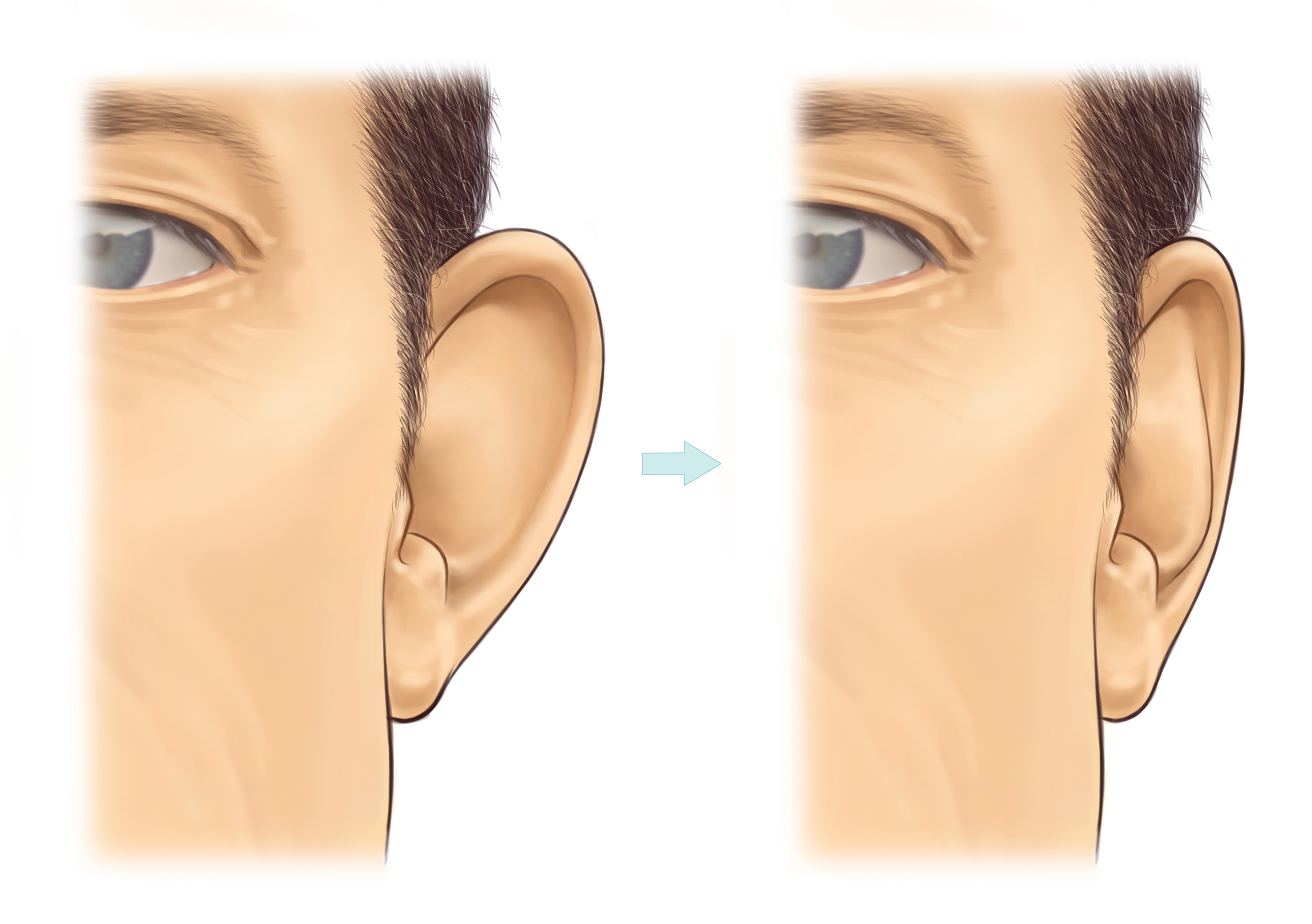 Prominent ears BAPRAS