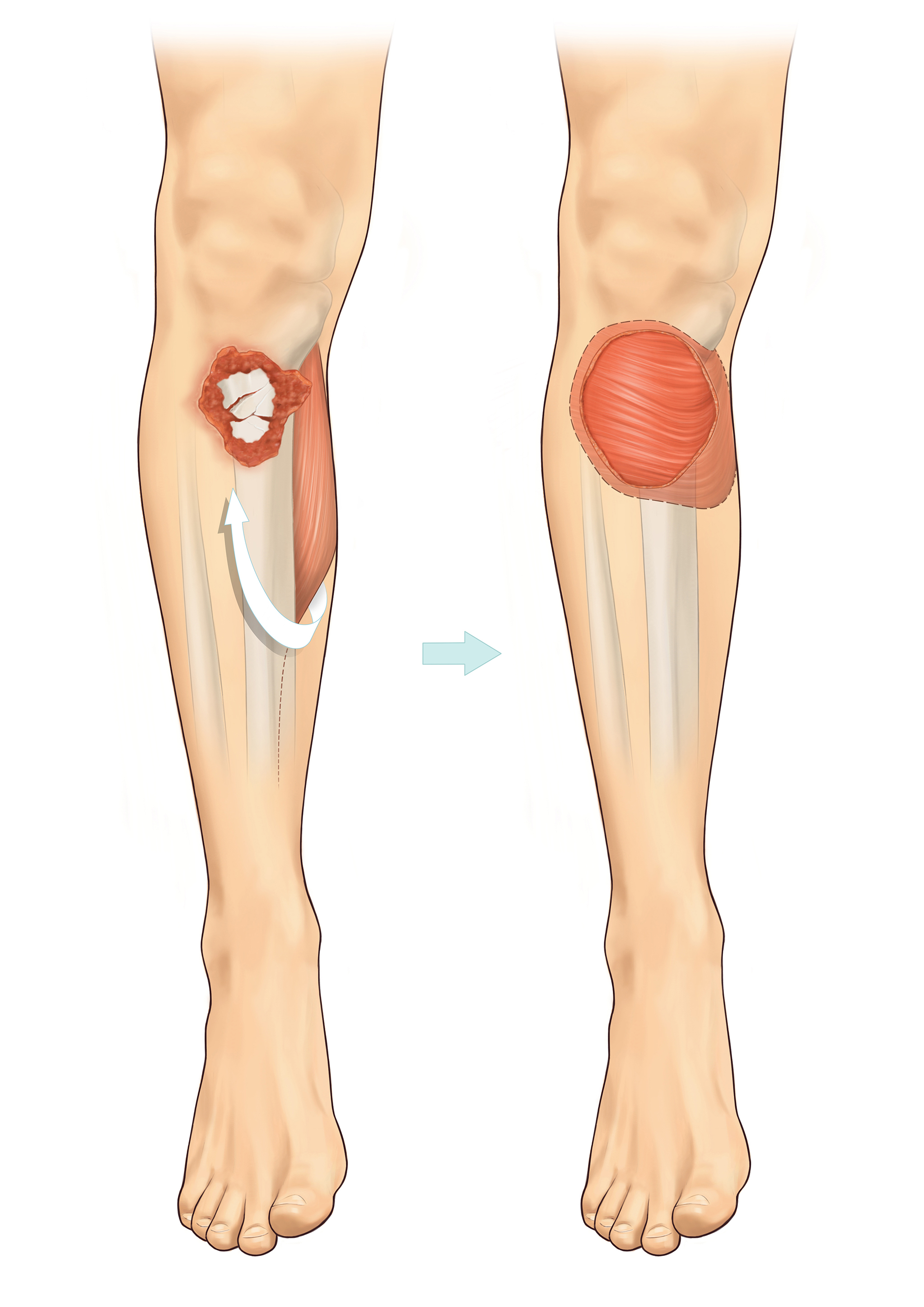 Open Fractures of the Lower Limb BAPRAS