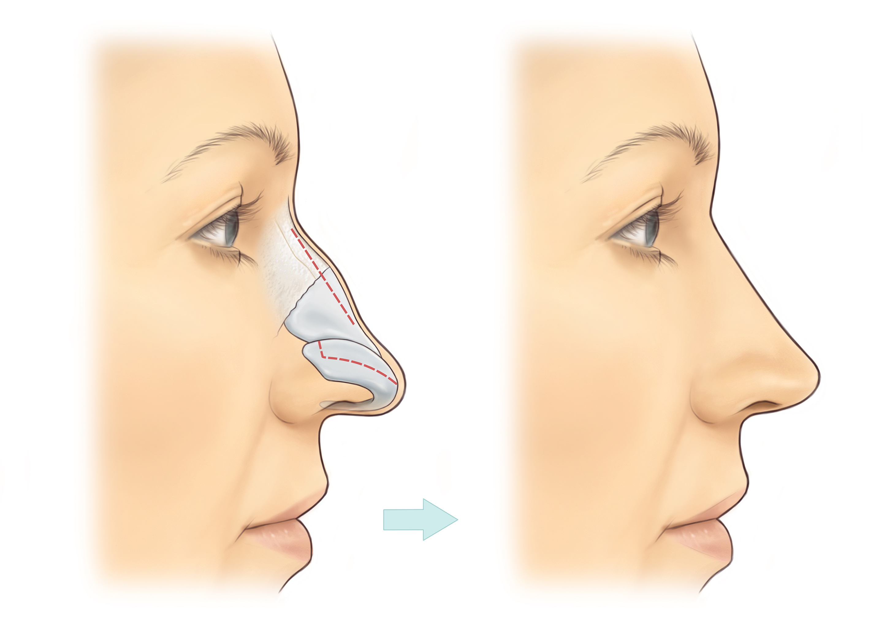 Rhinoplasty BAPRAS