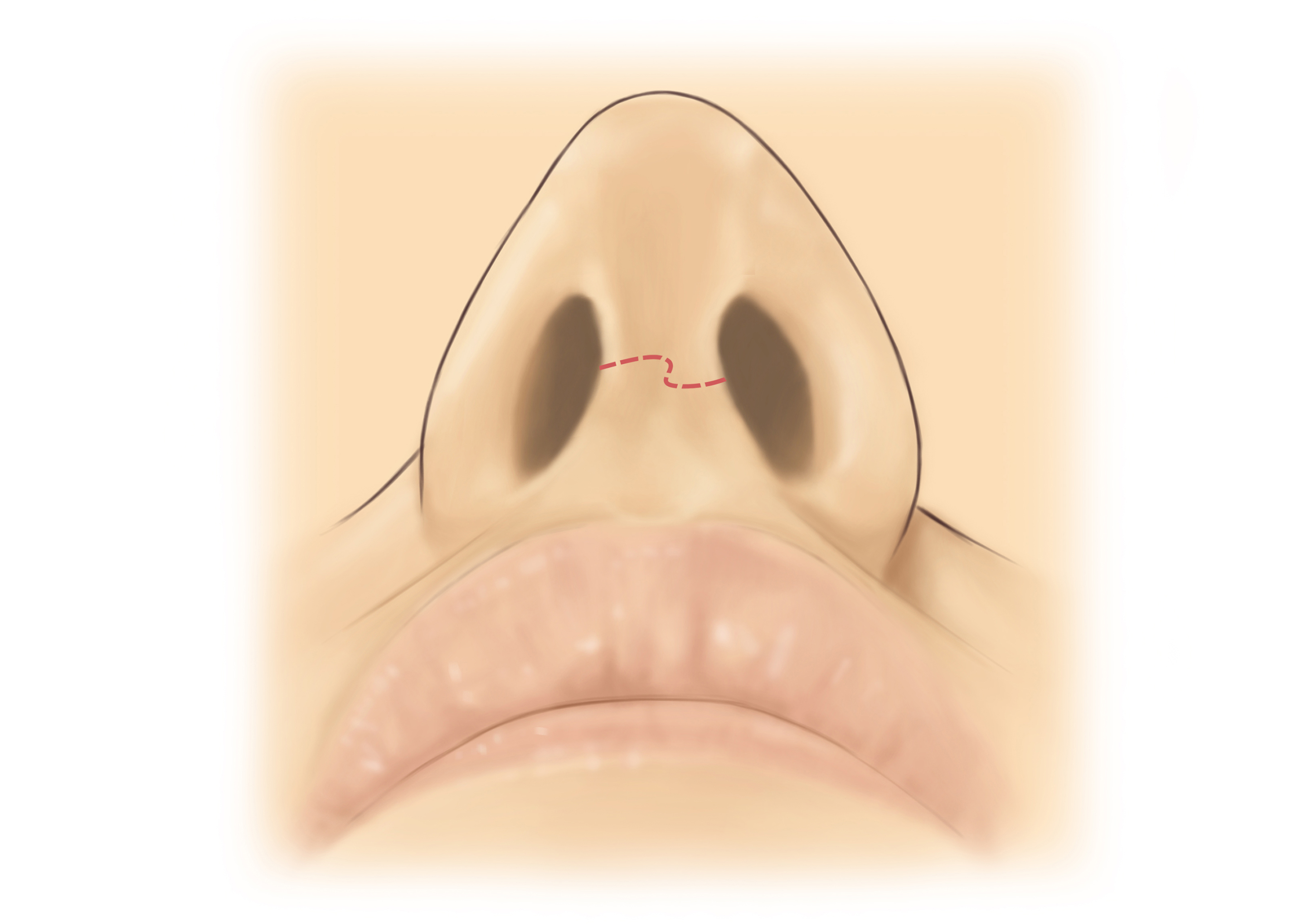 Rhynoplasty-preop nose
