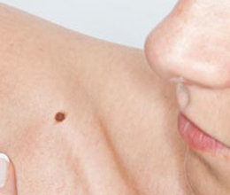 New NICE Melanoma: Assessment and Management - Clinical Guidance